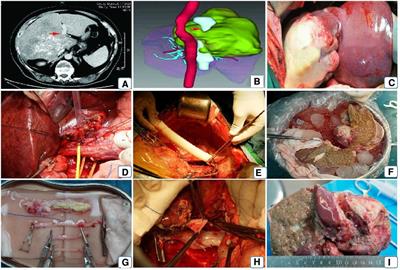 Single-center experience of Ex vivo liver resection and autotransplantation for complex hepatic alveolar echinoccosis